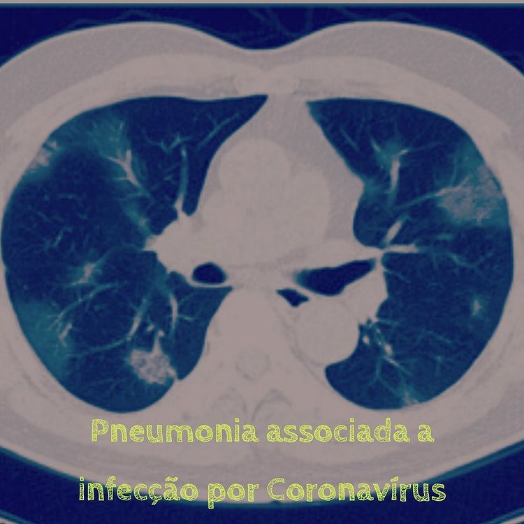 pneumonia associada coronavirus